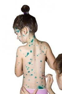 child-with-skin-problems-in-laguna-hills